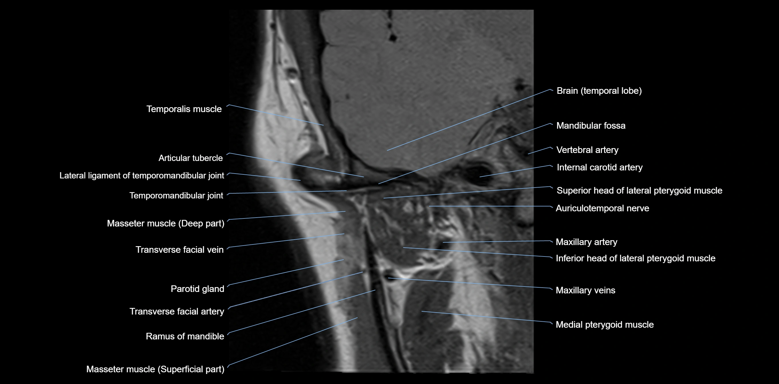 MRI TMJ coronal cross sectional 3T anatomy -img-00004-00002.webp